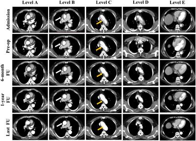 Single-branched stent-graft with on-table fenestration for endovascular repair of primary retrograde type A aortic dissection: A multicenter retrospective study
